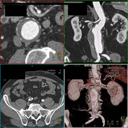 Abdominal Aortic Aneurysm (AAA) With Vascular Mapping - CTisus CT Scan