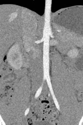 Dual Energy at 100 and 140 Kvp Shows Difference in Attenuation of Vascular Structures - CTisus CT Scan