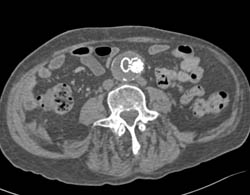 Endovascular Stent With One Limb Occluded - CTisus CT Scan