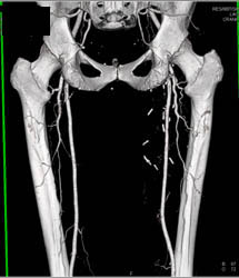 Bypass Grafts - CTisus CT Scan