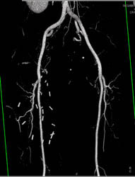 Bypass Grafts - CTisus CT Scan