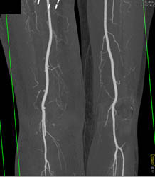 Bypass Grafts - CTisus CT Scan