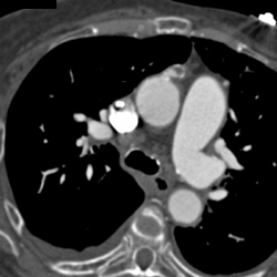 Focal Aneurysm Off Arch - CTisus CT Scan