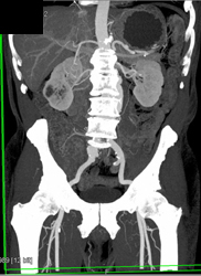 Abdominal Aortic Aneurysm (AAA) With Automated Editing Tool- VRT and MIP - CTisus CT Scan