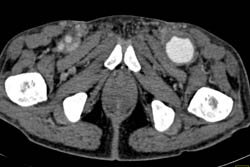 Pseudoaneurysm Groin - CTisus CT Scan