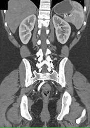 Bypass Graft From Aorta to SFA - CTisus CT Scan