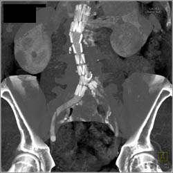 Failed Limb- Left- of Graft - CTisus CT Scan