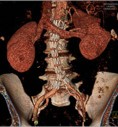 Endovascular Stent With Broken Stent Near Left Common Iliac Branching - CTisus CT Scan