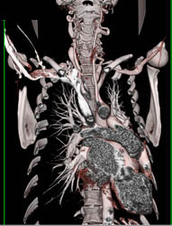 Ectatic Carotid Arteries in A Patient With Loeys-Dietz Syndrome - CTisus CT Scan