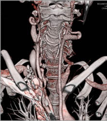 Aneurysm Off Subclavian Artery in Loeys-Dietz as Well as Ectatic Carotid Arteries - CTisus CT Scan