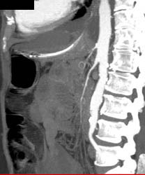 Small Caliber Celiac and SMA Vessels Lead to Low Flow State - CTisus CT Scan