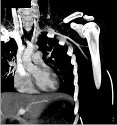 Stab Wound Axillary Artery With Bleed - CTisus CT Scan