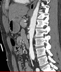 Superior Mesenteric Artery (SMA) Syndrome - CTisus CT Scan