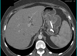 Superior Mesenteric Artery (SMA) Syndrome - CTisus CT Scan