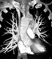 Dilated Right Innominate Artery - CTisus CT Scan