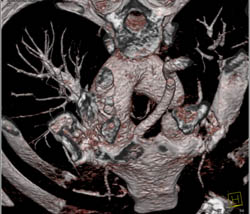 Tortuous Aorta Syndrome- Look at Aorta Especially in Abdomen - CTisus CT Scan