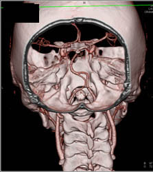 Loeys-Dietz Syndrome With Single Acquisition With Pitch of 3 on Flash Scanner. See the Sequence From Circle of Willis (COW) to Pelvis. Patient Also Has Median Arcuate Ligament Syndrome. - CTisus CT Scan