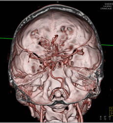 Loeys-Dietz Syndrome With Single Acquisition With Pitch of 3 on Flash Scanner. See the Sequence From Circle of Willis (COW) to Pelvis. Patient Also Has Median Arcuate Ligament Syndrome - CTisus CT Scan