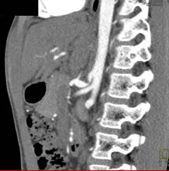 Median Arcuate Ligament Syndrome With Dilated IMA - CTisus CT Scan