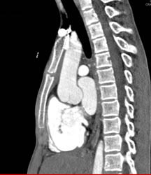 Coronary Arteries Are Seen on A Routine Non-gated Flash Scan as Part of Loeys-Dietz Evaluation - CTisus CT Scan