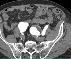 Iliac Artery Aneruysms Including Common Iliac Artery Aneurysms and Right Internal Iliac Artery - CTisus CT Scan