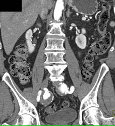 Iliac Artery Aneurysms - Vascular Case Studies - CTisus CT Scanning