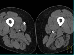 Stents in SFAs Bilaterally With Stenosis of Right SFA - CTisus CT Scan