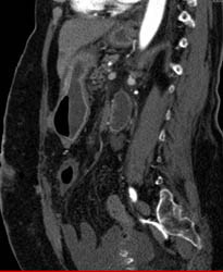 Occlusion of SMA With Ischemic Bowel - CTisus CT Scan