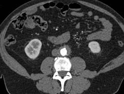 Iliac Artery Aneurysms With MIP and VRT Reconstructions - CTisus CT Scan