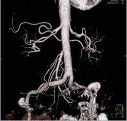 Fibromuscular Dysplasia (FMD) Right Left Artery - CTisus CT Scan