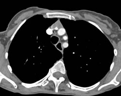 Normal Branch Vessels Off Arch - CTisus CT Scan