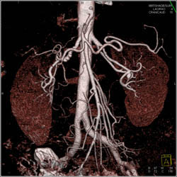 Fibromuscular Dysplasia (FMD) Right Renal Artery and Small Aneurysm Left Renal Artery - CTisus CT Scan