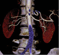 Pre-hilar Branching Right Renal Artery in A Donor - CTisus CT Scan