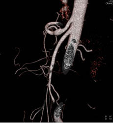 Focal Aneurysm Celliac Artery - CTisus CT Scan