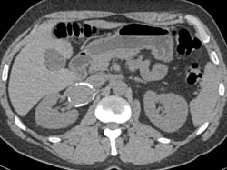 Large Renal Artery Aneurysm Simulates An Adrenal Mass - CTisus CT Scan