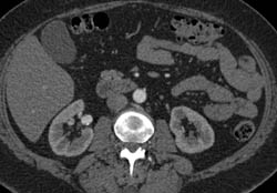 Right Renal Artery Aneurysm and Left Renal Angiomyelolipoma - CTisus CT Scan