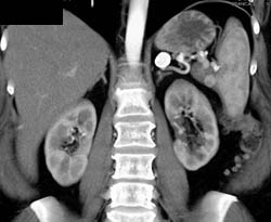 Splenic Artery Aneurysm Plus Renal Artery Aneurysm- Same Case as Figure 30 - CTisus CT Scan