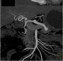 Median Arcuate Ligament Syndrome - CTisus CT Scan