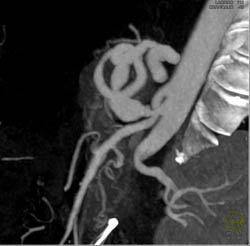 Median Arcuate Ligament Syndrome - CTisus CT Scan