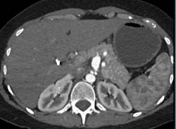 Median Arcuate Ligament Syndrome - CTisus CT Scan