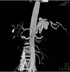 Median Arcuate Ligament Syndrome - CTisus CT Scan