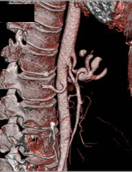 Median Arcuate Ligament Syndrome - CTisus CT Scan