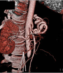 Median Arcuate Ligament Syndrome - CTisus CT Scan