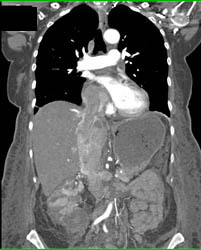 Renal Cell Carcinoma Extends Into IVC and Right Atrium - CTisus CT Scan