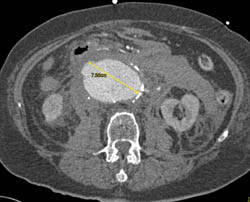 Active Bleed Abdominal Aortic Aneurysm - CTisus CT Scan