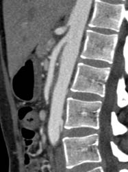 Superior Mesenteric Artery (SMA) Syndrome - CTisus CT Scan