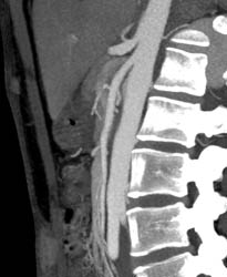 Superior Mesenteric Artery (SMA) Syndrome - CTisus CT Scan