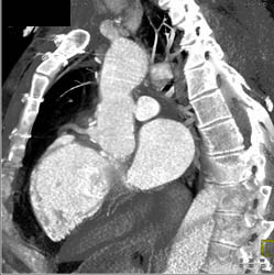 Type B Dissection - CTisus CT Scan