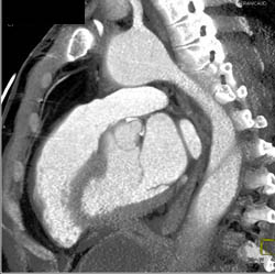 Type B Dissection - CTisus CT Scan