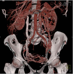 Pelvic Congestion With Huge Gonadal Veins - CTisus CT Scan